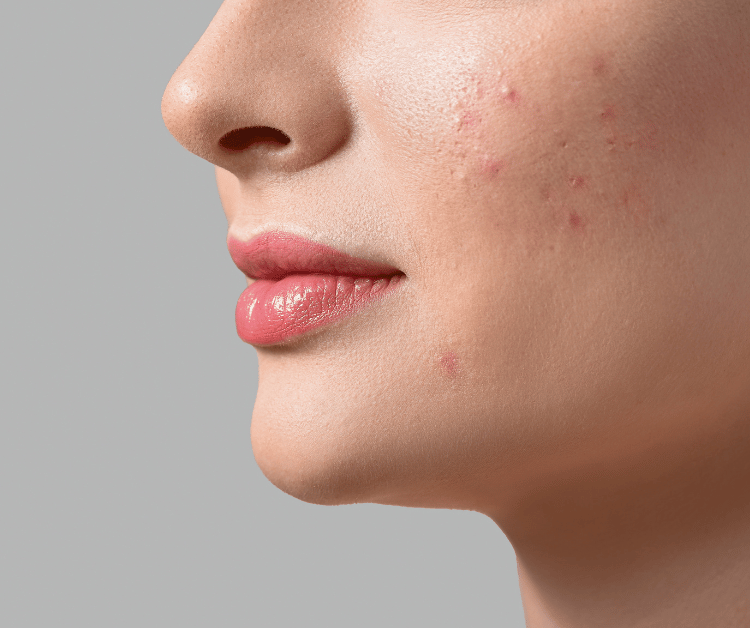 Acne on Sensitive Skin Type Woman