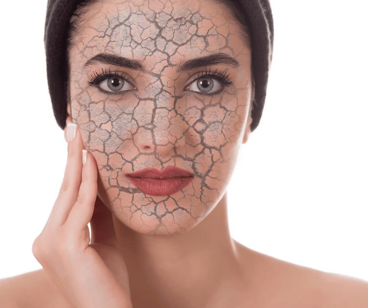 Dry Cracked Skin on Sensitive Skin Type Woman