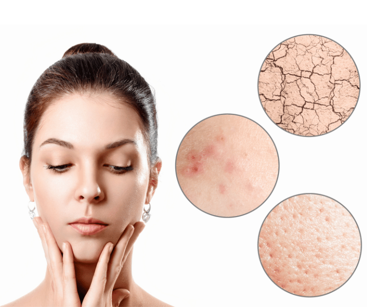 Woman with Dry Skin Characteristics Shown in Bubbles