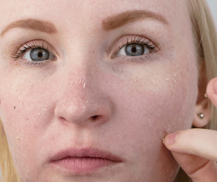 Woman with Flaky Skin Dry Skin Type